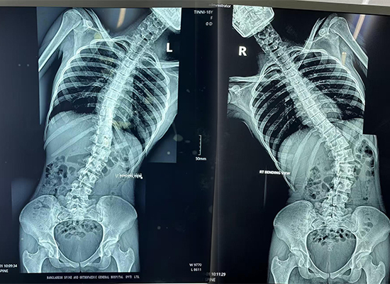 Preoperative full-spine X-ray of a 16-year-old scoliosis patient in Dhaka, Bangladesh-czmeditech Radiographie préopératoire de toute la colonne vertébrale d'un patient de 16 ans atteint de scoliose à Dhaka, Bangladesh-czmeditech