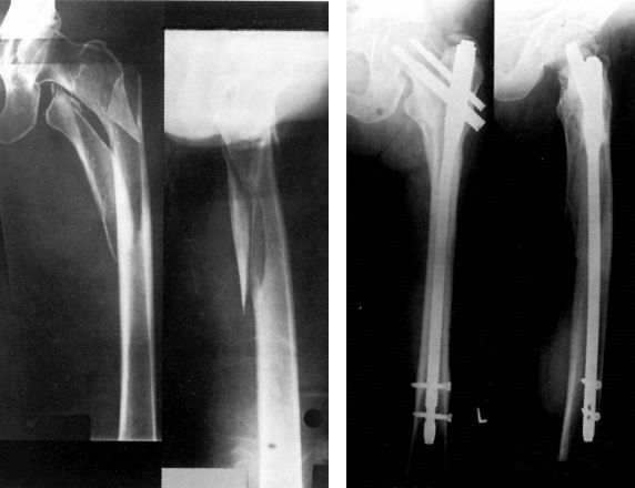 Fracture fémorale proximale-fracture intertrochantérienne