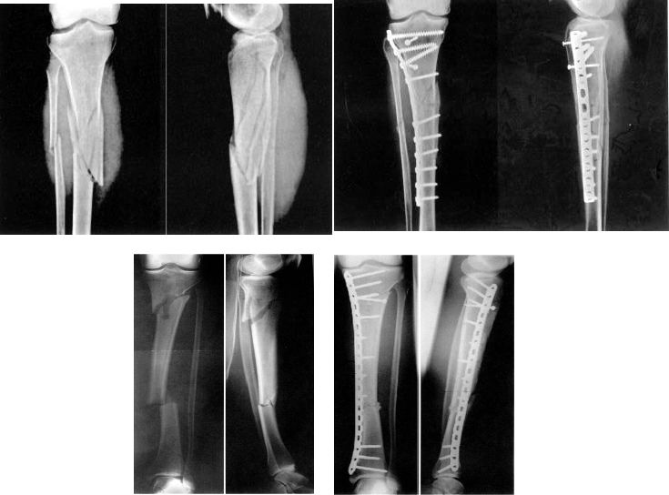 Fracture de la diaphyse tibiale