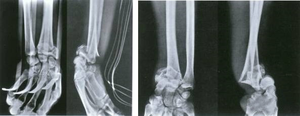 Fracture distale du radius