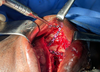 intraoperative-view-maxillofacial-plate-fixation-ghana2-czmeditech vue-peropératoire-fixation-par-plaque-maxillo-faciale-ghana2-czmeditech
