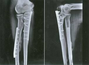 Double fracture de l'avant-bras