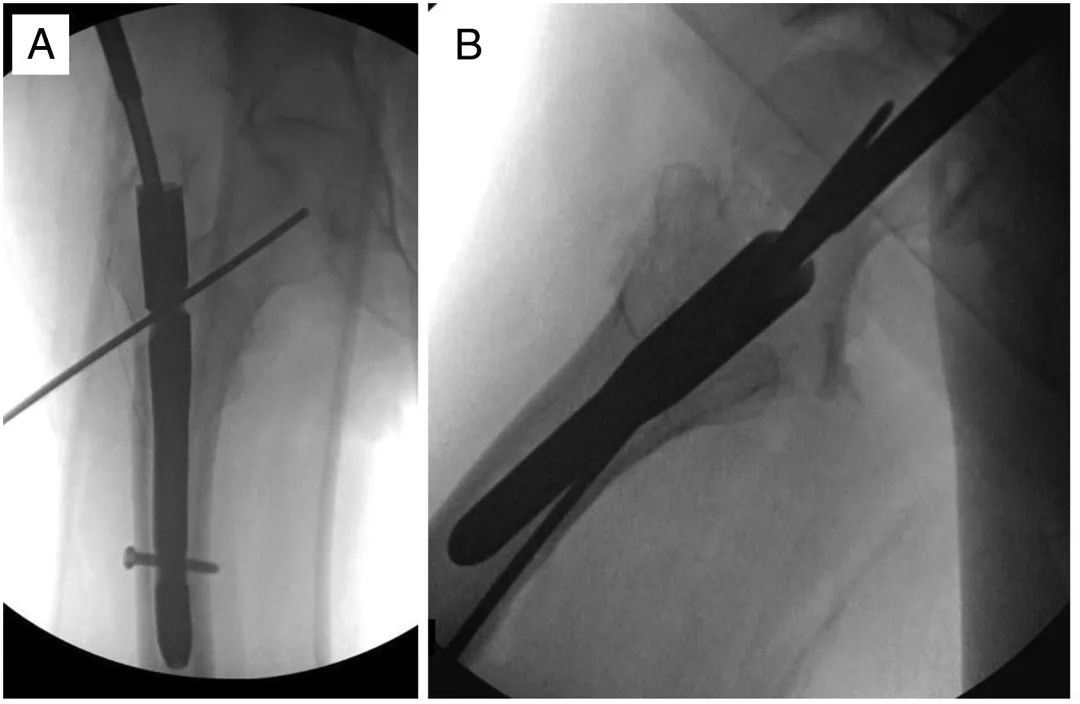 Clou intramédullaire