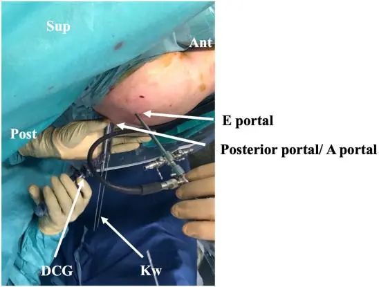 Traitement arthroscopique de l'instabilité postérieure de l'épaule