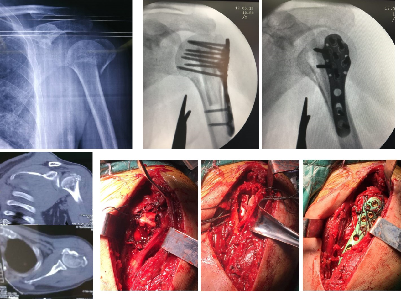 Fracture de l'humérus proximal