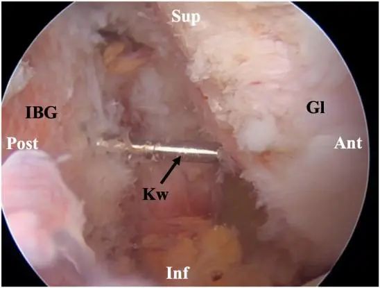 Traitement arthroscopique de l'instabilité postérieure de l'épaule