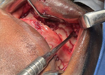 intraoperative-view-maxillofacial-plate-fixation-ghana1-czmeditech vue-peropératoire-fixation-par-plaque-maxillo-faciale-ghana1-czmeditech