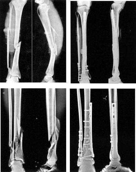 Fracture de la diaphyse tibiale