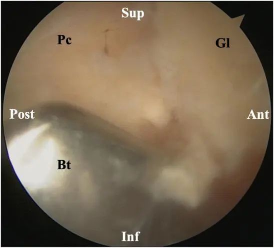 Traitement arthroscopique de l'instabilité postérieure de l'épaule