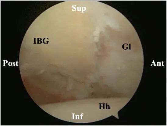 Traitement arthroscopique de l'instabilité postérieure de l'épaule