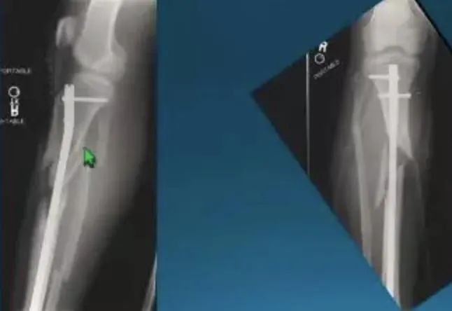 tibial intramédullaire
