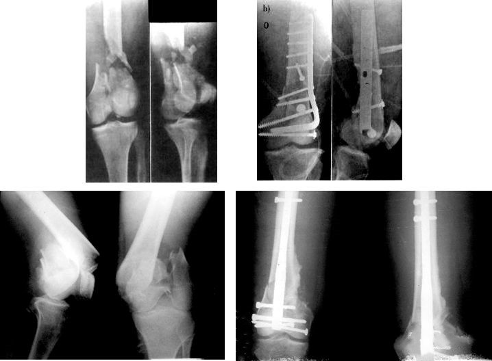 Fracture fémorale distale