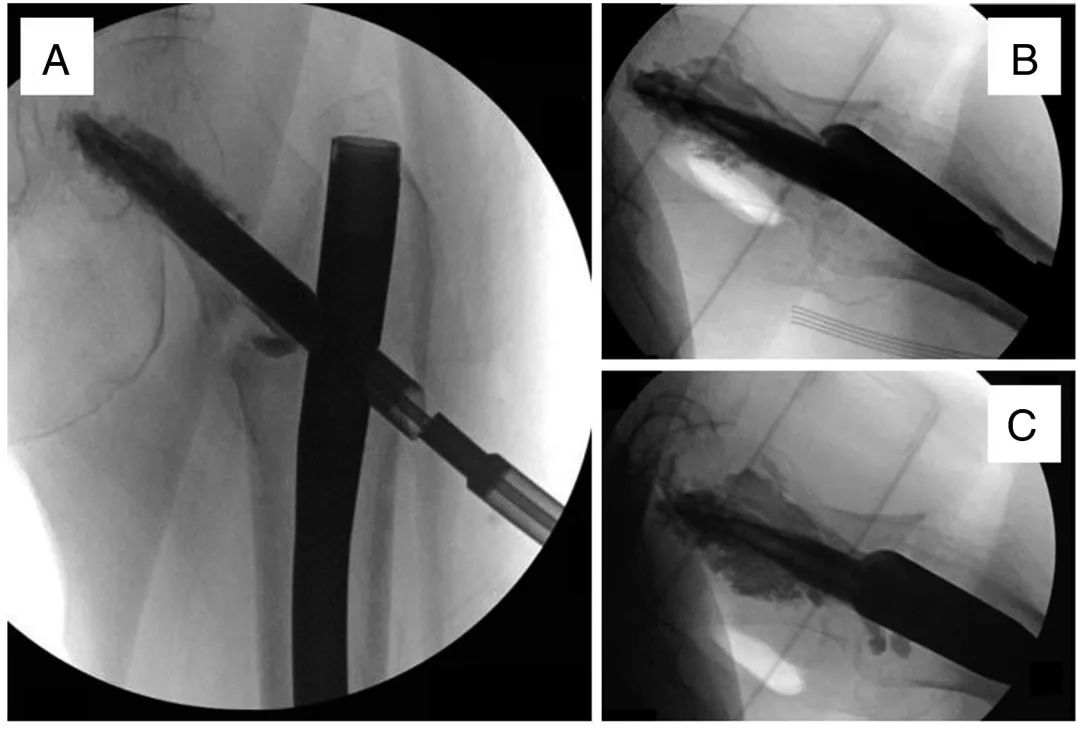Clou intramédullaire