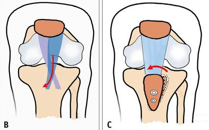 traitement de l'instabilité de l'articulation fémoro-patellaire chez l'enfant