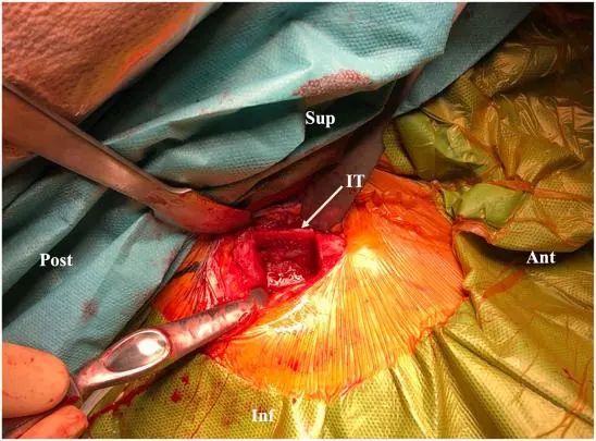 Traitement arthroscopique de l'instabilité postérieure de l'épaule