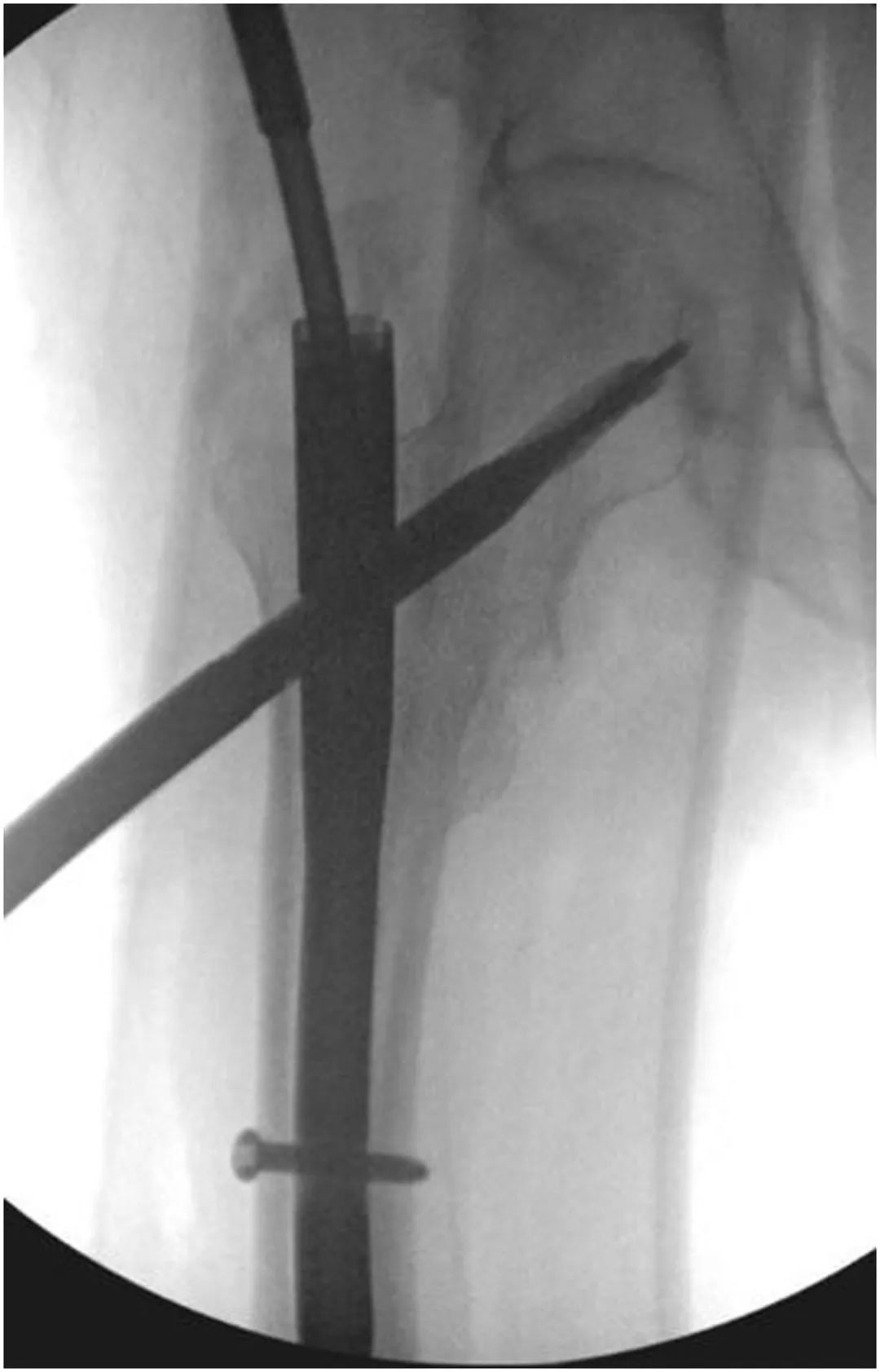 Clou intramédullaire