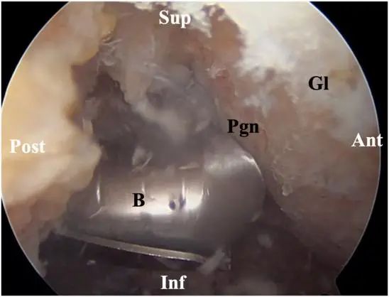 Traitement arthroscopique de l'instabilité postérieure de l'épaule
