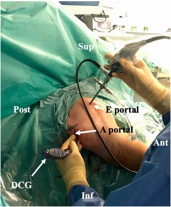 Traitement arthroscopique de l'instabilité postérieure de l'épaule