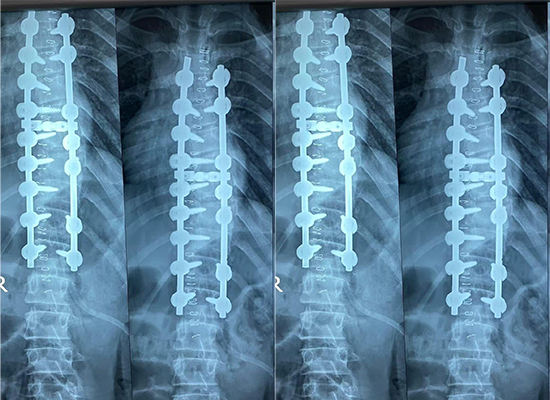 postoperative spinal x-ray showing corrected alignment after scoliosis surgery with pedicle screws-czmeditech radiographie postopératoire de la colonne vertébrale montrant l'alignement corrigé après une chirurgie de la scoliose avec des vis pédiculaires-czmeditech