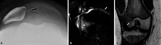 traitement de l'instabilité de l'articulation fémoro-patellaire chez l'enfant