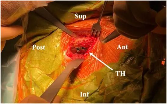 Traitement arthroscopique de l'instabilité postérieure de l'épaule
