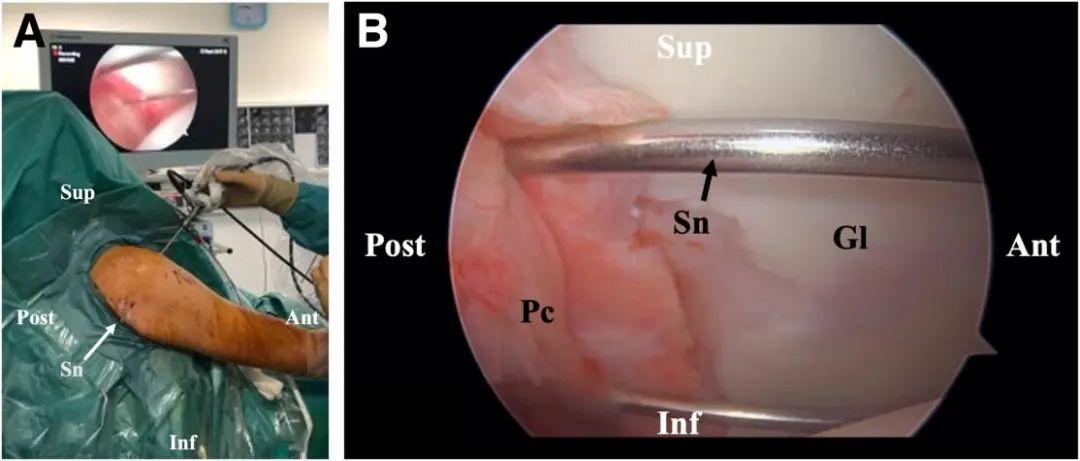 Traitement arthroscopique de l'instabilité postérieure de l'épaule