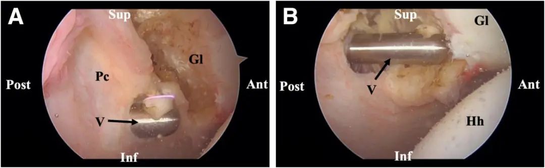 Traitement arthroscopique de l'instabilité postérieure de l'épaule