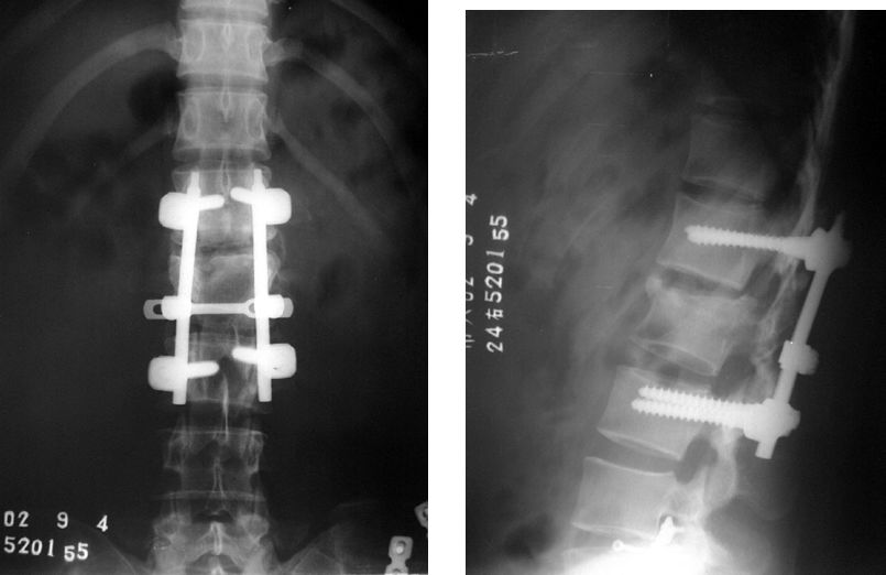 Fracture de la colonne vertébrale