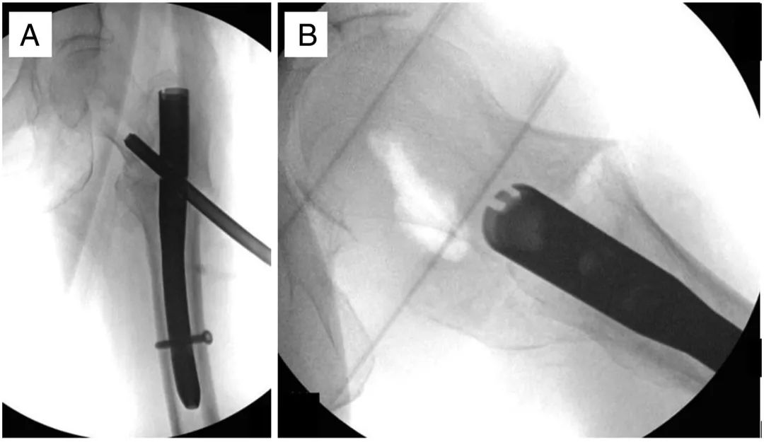 Clou intramédullaire