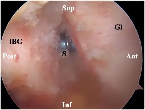 Traitement arthroscopique de l'instabilité postérieure de l'épaule