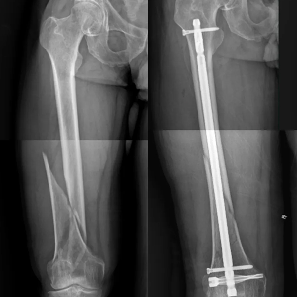 Ongle intramédullaire du fémur distal DFN
