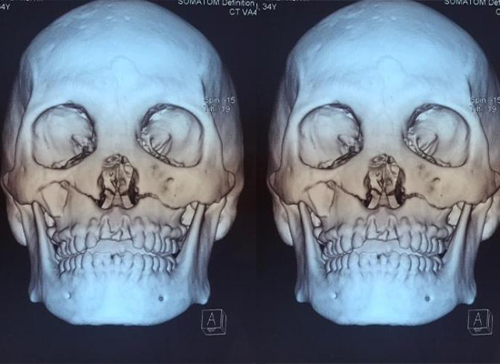 preoperative-imaging-lefort-fracture-ghana-czmeditech imagerie-préopératoire-fracture-de-lefort-ghana-czmeditech
