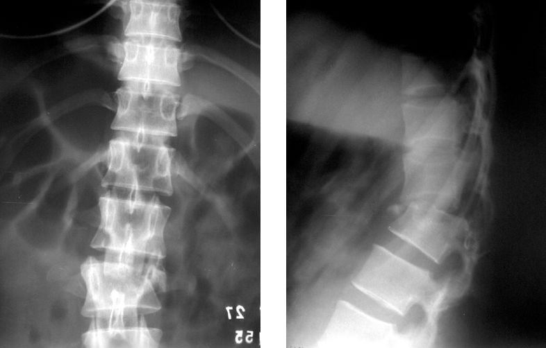 Fracture de la colonne vertébrale