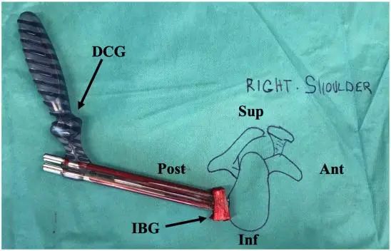 Traitement arthroscopique de l'instabilité postérieure de l'épaule