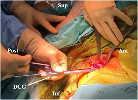 Traitement arthroscopique de l'instabilité postérieure de l'épaule