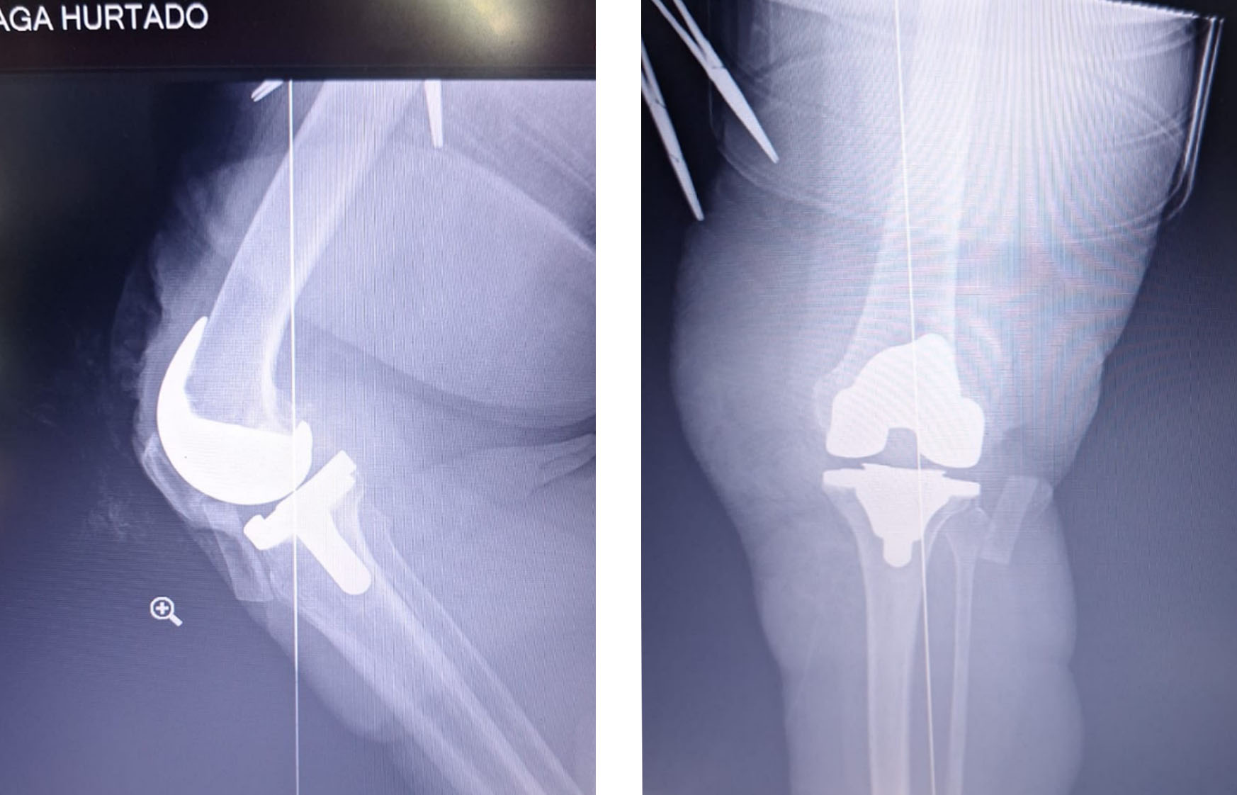 tkr-postopératoire-xray-prothèse-de-genou