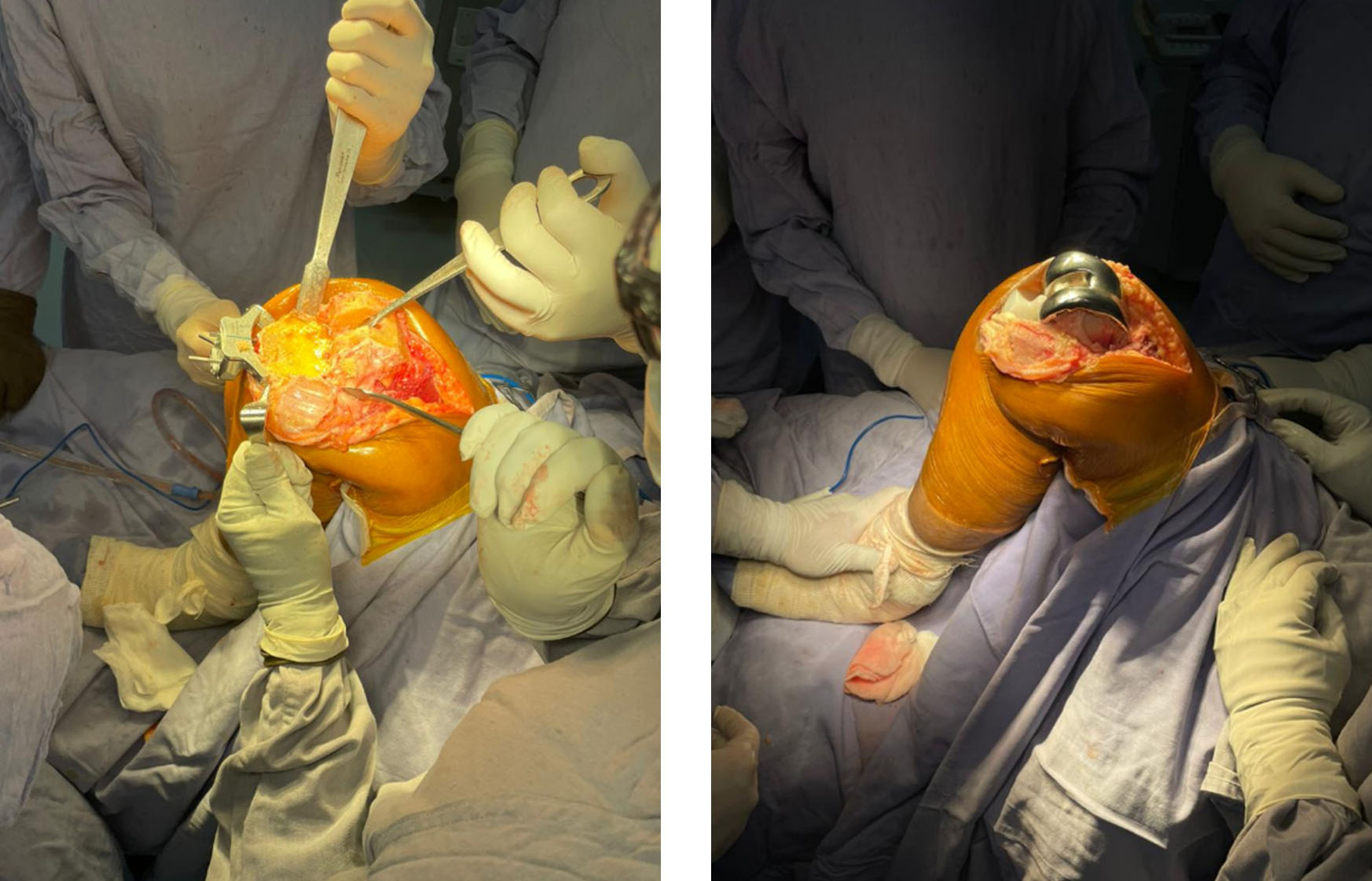 implant-chirurgie-tkr-peropératoire.