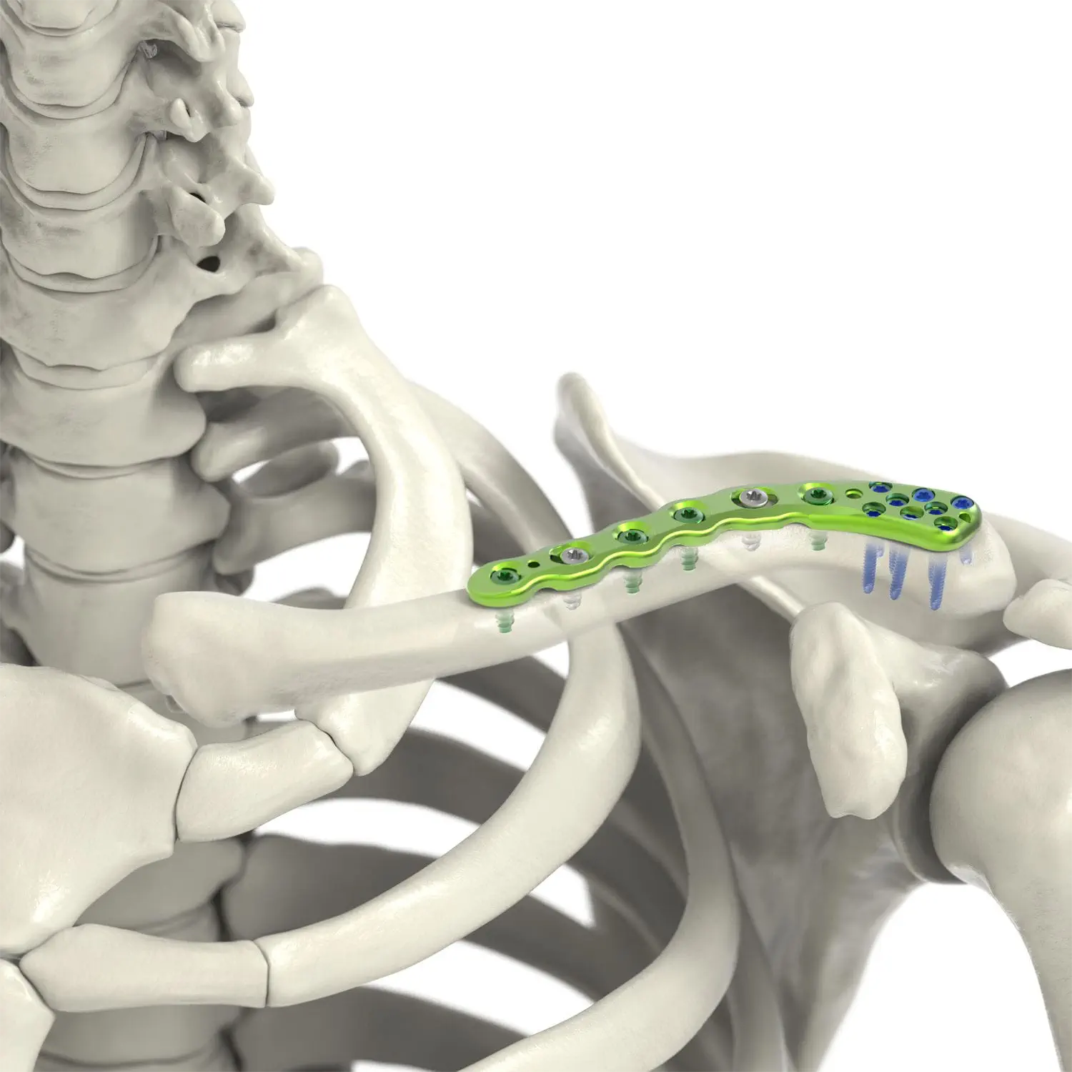 Plaque de verrouillage de la clavicule : amélioration de la guérison et de la stabilité
