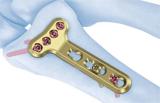 Plaque de verrouillage distale du rayon palmaire