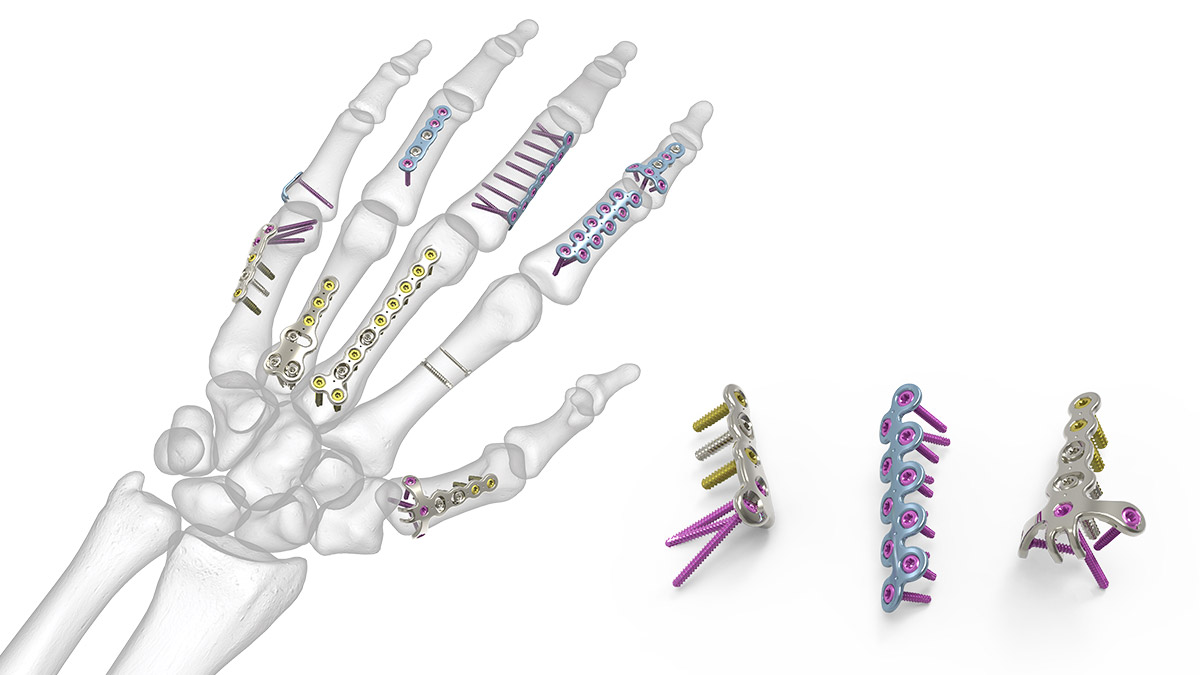 Plaque de verrouillage m&eacute;tacarpienne