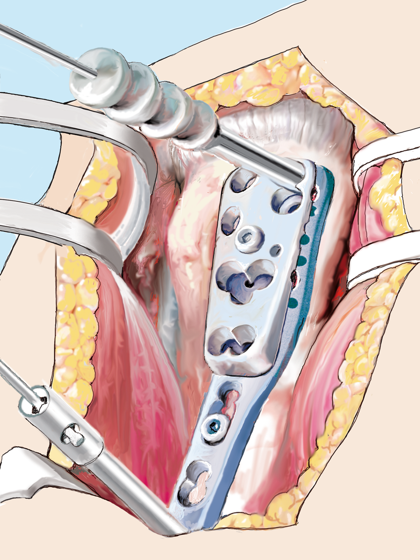 Plaque de verrouillage hum&eacute;rale proximale