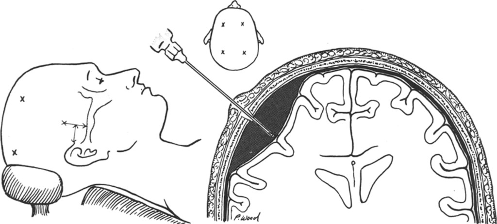 Foret de craniotomie autotaraudeur