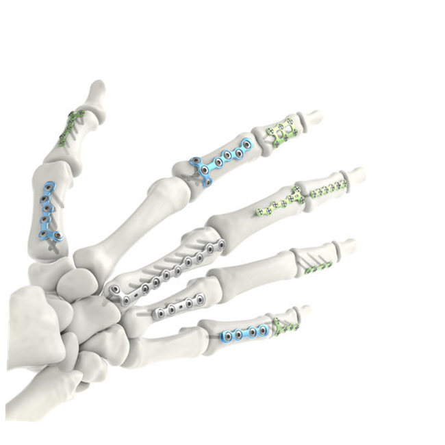 Plaques de verrouillage métacarpiennes : avancées dans le traitement des fractures de la main