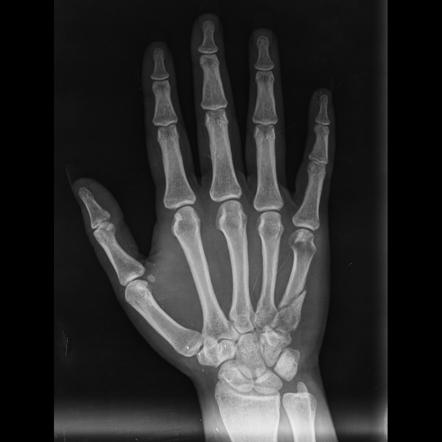 Plaques de verrouillage m&eacute;tacarpiennes