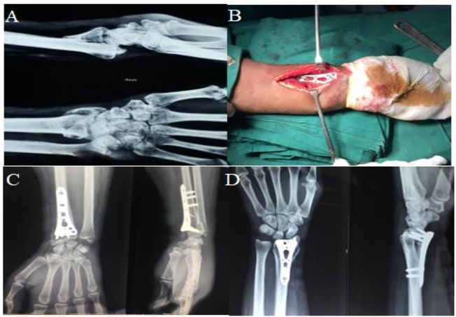 chirurgie des plaques verrouillables