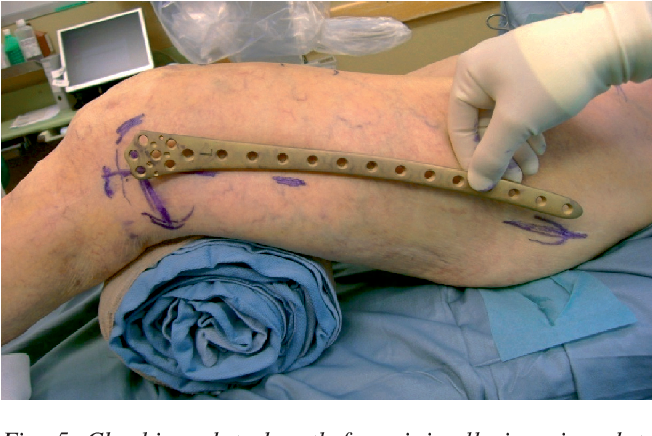 Chirurgie de la plaque de verrouillage : une approche avancée du traitement des fractures osseuses