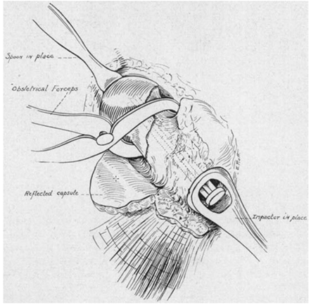 Clou intram&eacute;dullaire