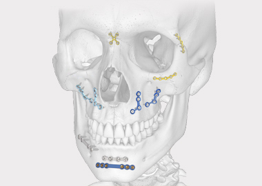 Système de placage maxillofacial