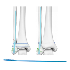 Ongle intramédullaire fibulaire expert