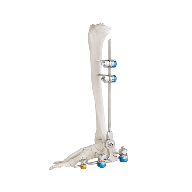 Fixateur externe de joint de fusion de la cheville